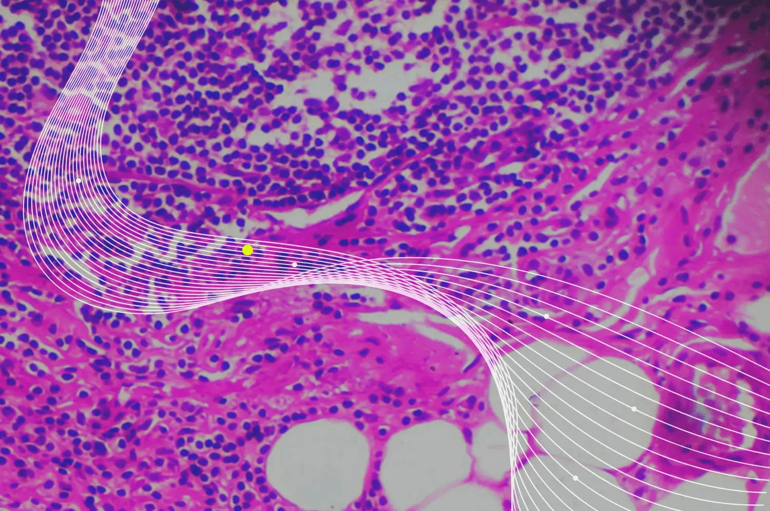 nash biomarker case study